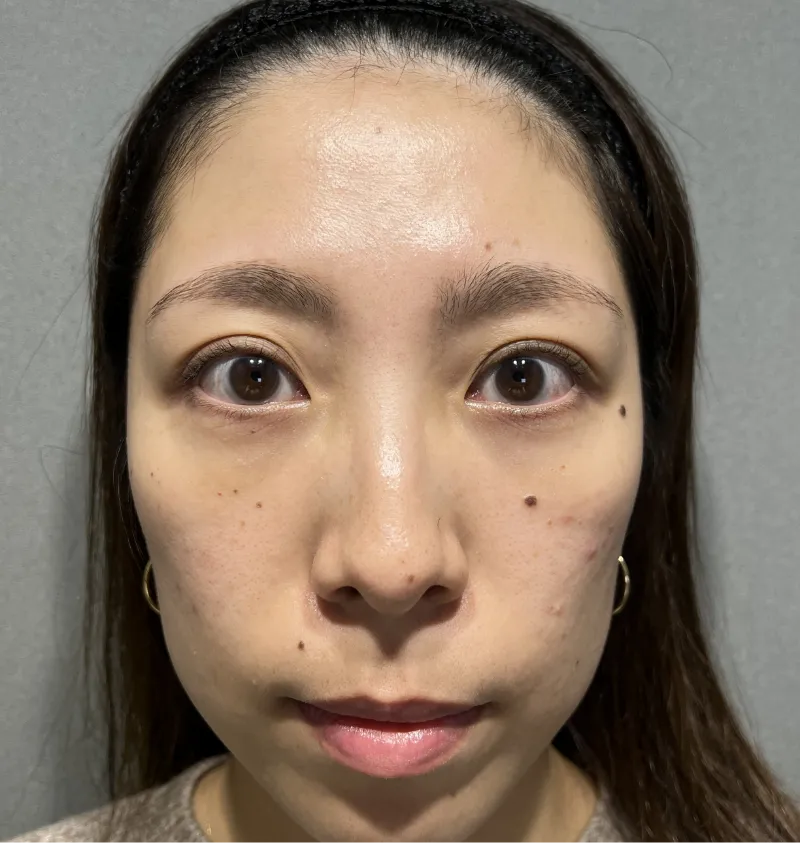 クマ取り Pick Up症例01 After