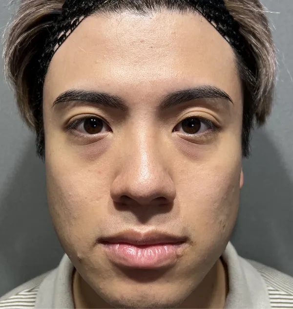 クマ取り Pick Up症例02 Before