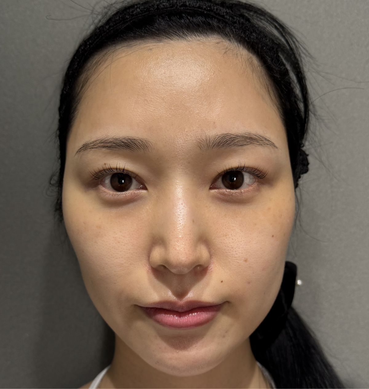 クマ取り＋脂肪注入 症例pickup01 After