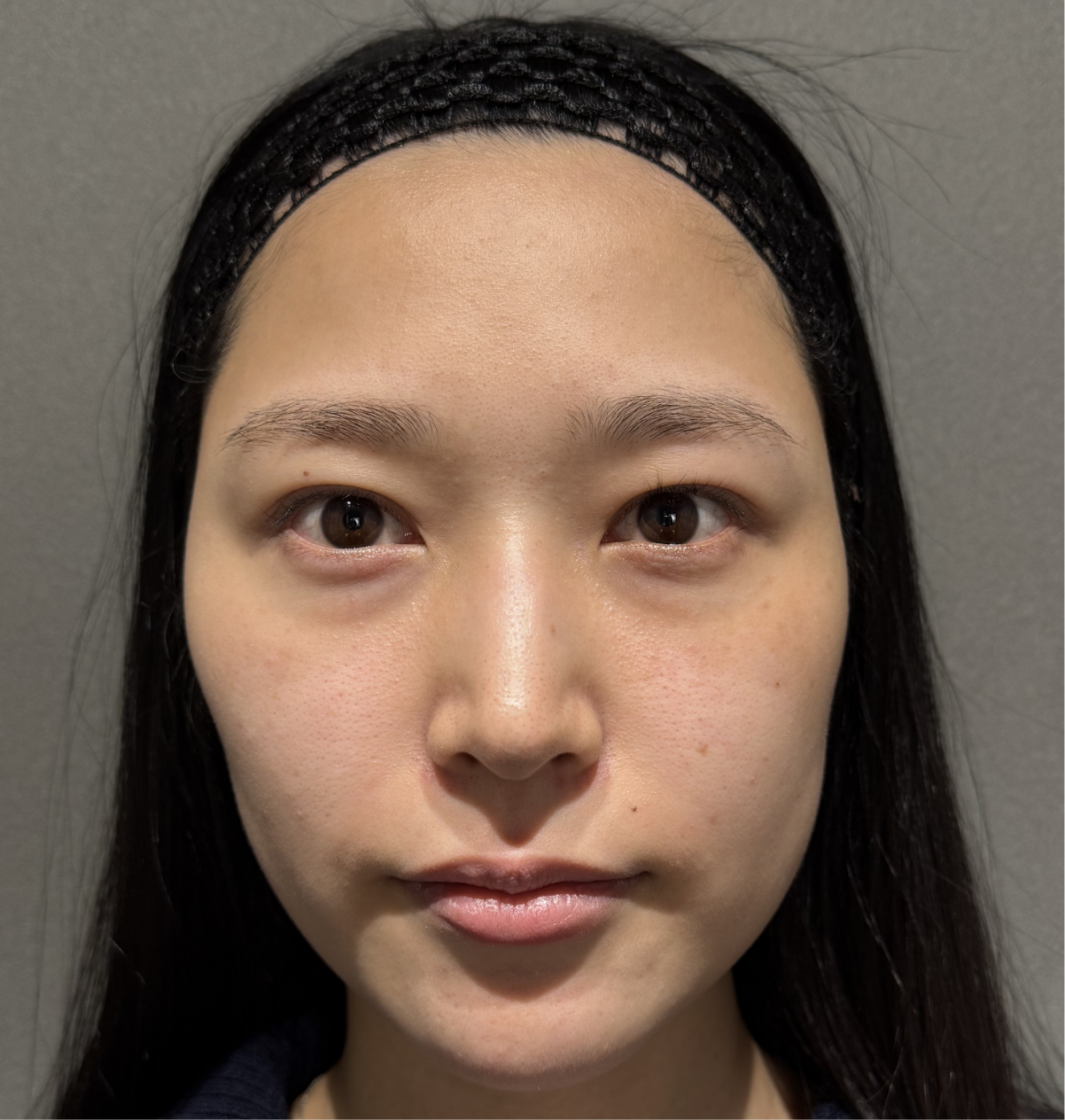 クマ取り＋脂肪注入 症例pickup01 Before