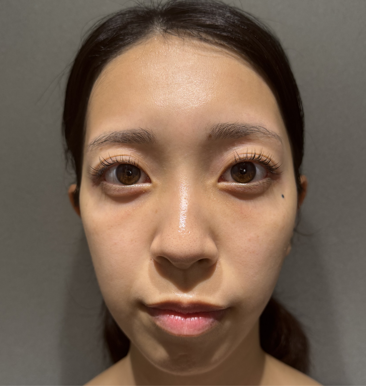 クマ取り＋脂肪注入 症例pickup After