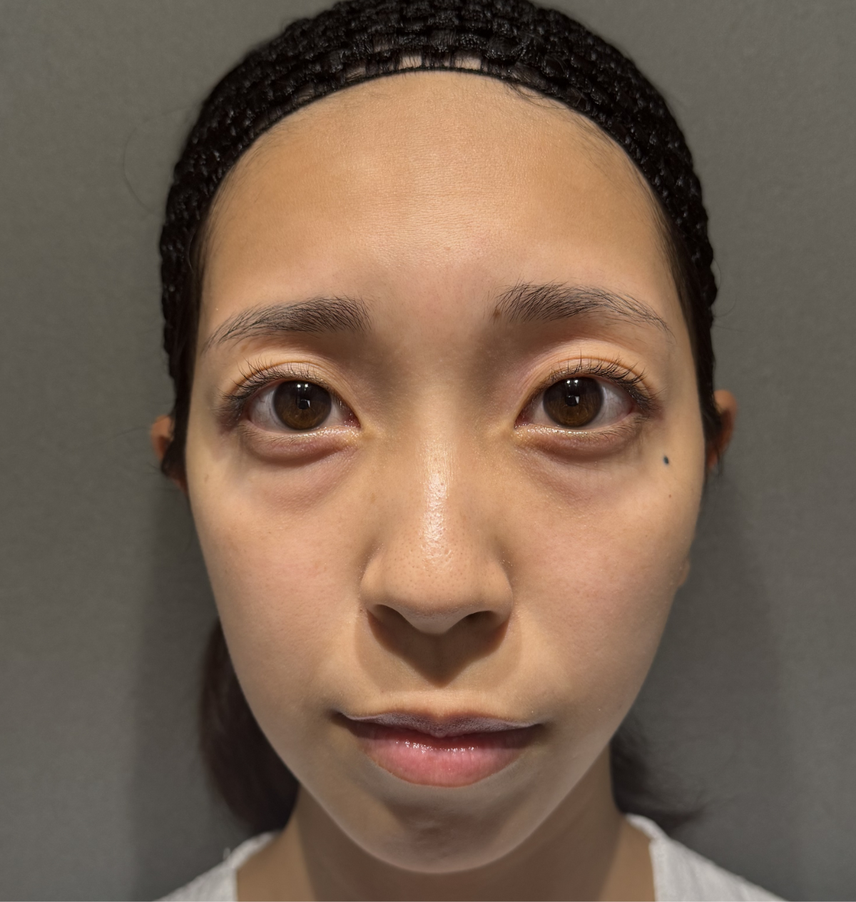 クマ取り＋脂肪注入 症例pickup Before